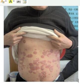 牛皮癣贵患者的直接性危害有哪些
