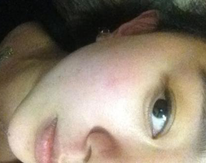 激素依赖性皮炎的症状是什么样子的