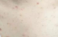 季节性皮炎患者的日常护理办法应科学化的掌控