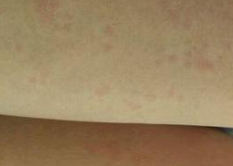 慢性荨麻疹的日常自我护理工作 