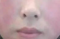 致使季节性皮炎产生的诱发因素