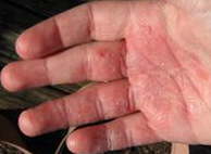 手部湿疹进行预防的有效护理办法 