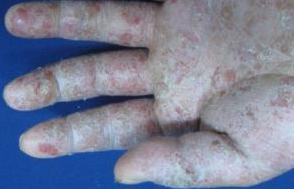 冬季进行手部湿疹护理的常规办法 