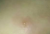 知悉丘疹性荨麻疹的症状体现特点