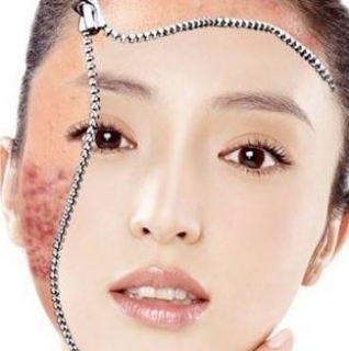 脸部痤疮用什么方法治疗效果好