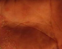 手部湿疹呈现的诱发因素应该清晰了解 