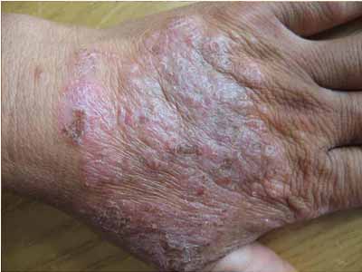 手部湿疹是什么原因导致的 