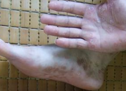 手足癣疾患呈现的症状特点 