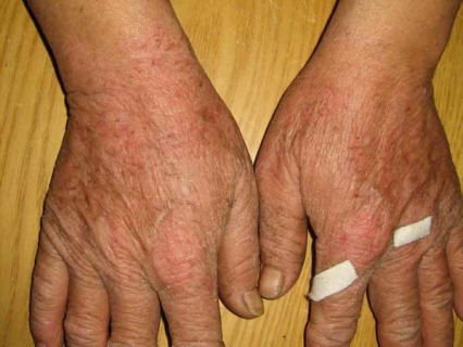 手部湿疹症状表现有什么 