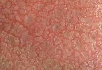 防止季节性皮炎呈现的护理办法