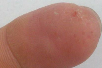 手癣病症进行治疗的中药方