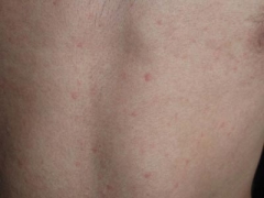 青岛急性荨麻疹的临床症状 