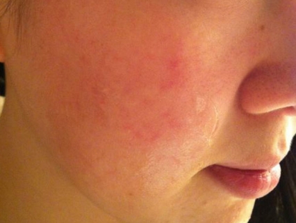 脸上皮肤过敏会给患者带来哪些影响 
