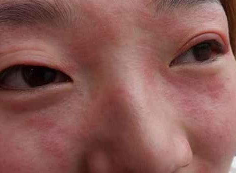 面部呈现皮肤过敏状况的护理方法