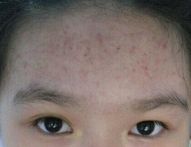 痤疮和遗传有什么必然的关系