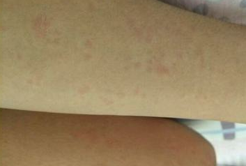 科学利用慢性荨麻疹病症进行防治的办法