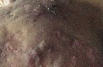 痤疮最易被诱发的致病因素