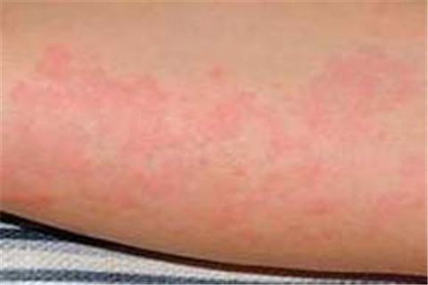 常见的季节性皮炎有哪些症状特点 