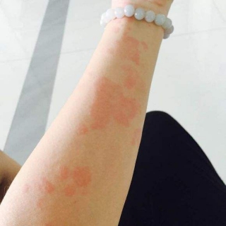 急性荨麻疹会有什么症状发生