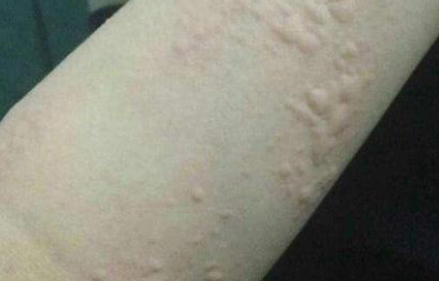 过敏性荨麻疹进行治疗的饮食办法