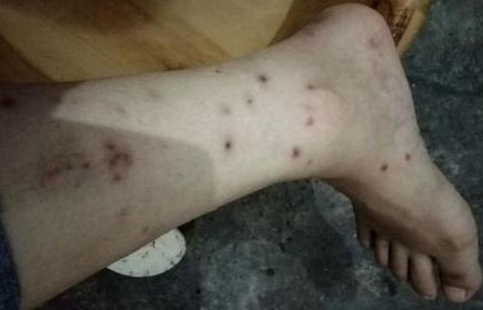 丘疹性荨麻疹进行医治的办法