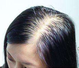 怎么预防脂溢性皮炎造成的脱发 
