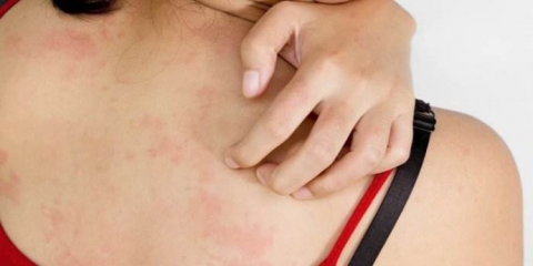 怎么避免慢性荨麻疹的发生 