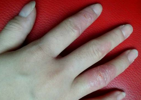 手部湿疹应该如何进行相应的护理 