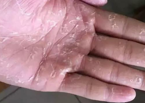 慢性湿疹进行相应医治的偏方