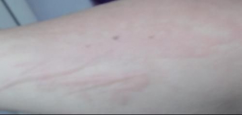 荨麻疹有什么发病特点