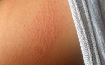 划痕性荨麻疹产生的症状表现特点