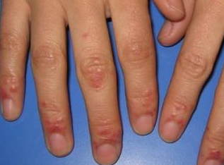 是什么原因导致了急性湿疹 