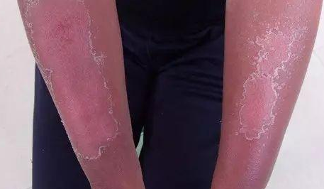 日光性皮炎及其生发的症状表现特点
