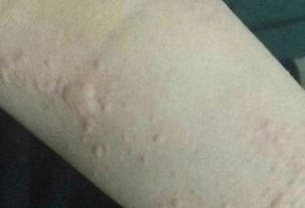 过敏性荨麻疹进行护理的要点 