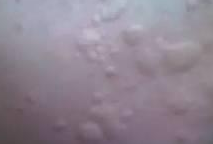 丘疹性荨麻疹呈现的症状表现