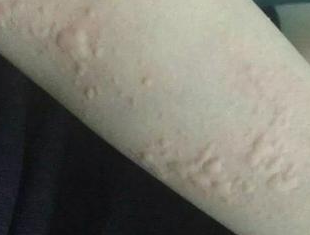 急性荨麻疹患者进行饮食的日常注意事项