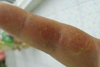 导致手部湿疹产生的原因有什么 