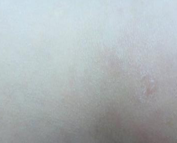异位性皮炎为什么会发作的原因