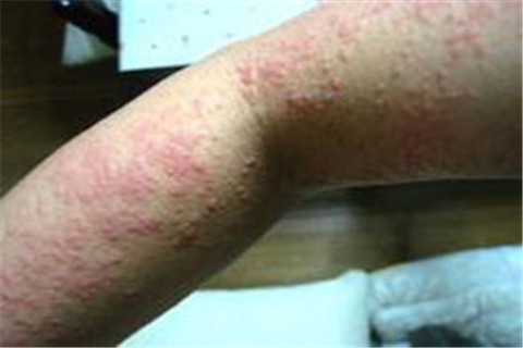 青岛春季如何预防湿疹 
