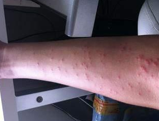 丘疹性荨麻疹呈现的病因与症状体现特点