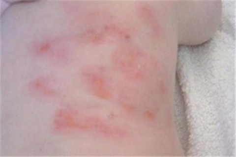 春季得了过敏性皮炎湿疹怎么办 