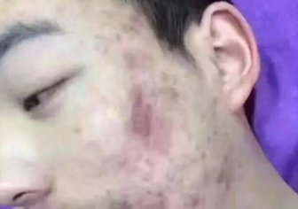 生成痤疮疾患的日常呵护办法