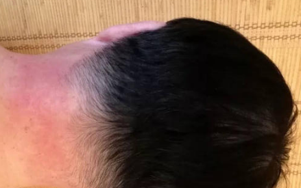 日光性皮炎的症状与防备办法