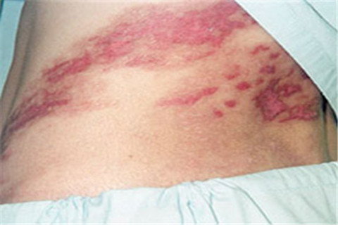 青岛什么是过敏性湿疹 