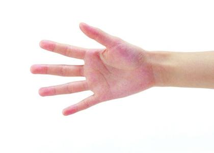 手指皲裂性湿疹怎么治 