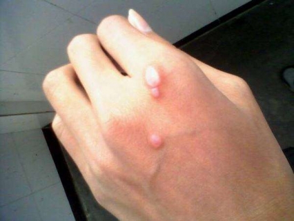 日常怎么预防扁平疣的发生