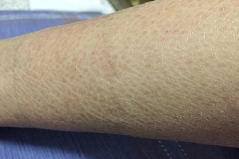 鱼鳞病的症状是什么样的