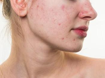 皮肤过敏的常见治疗方法 