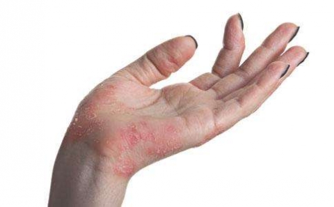 皮肤湿疹有什么治疗方法 
