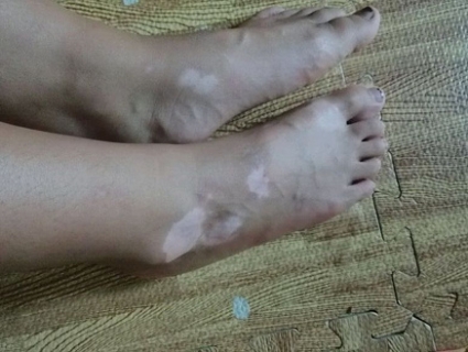 白癜风发病会有什么表现